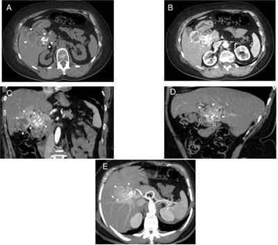 Hepatic incidentaloma: An asymptomatic ectopic thyroid tissue